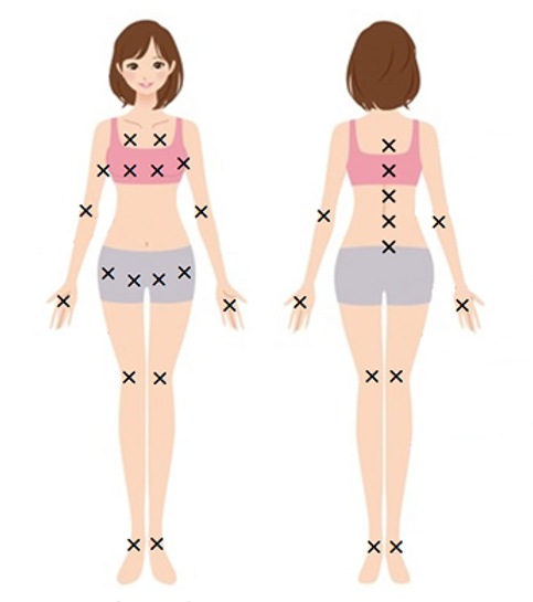 セルフハイフ照射ができない箇所